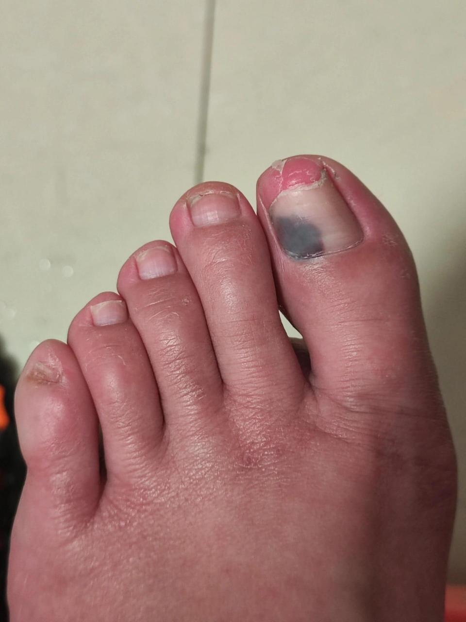 有姐们知道我脚指甲怎么回事吗 不知道我这个大脚指的脚上怎么黑了一