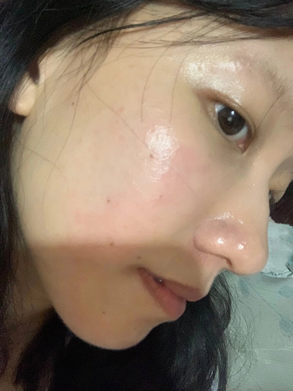 说脸上小疙瘩是粉刺开了阿达帕林和尿素软膏.