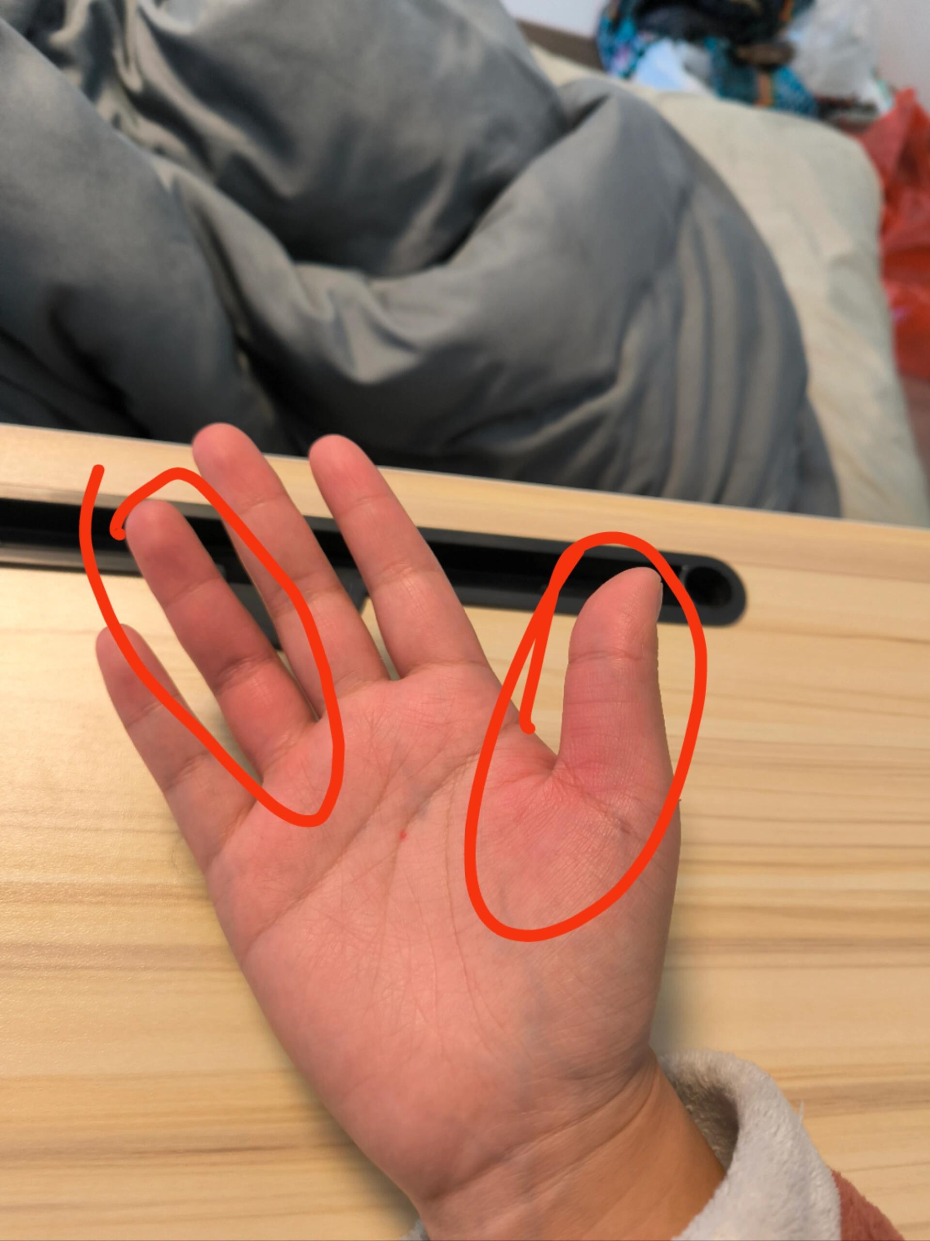 啊?罗红霉素过敏?