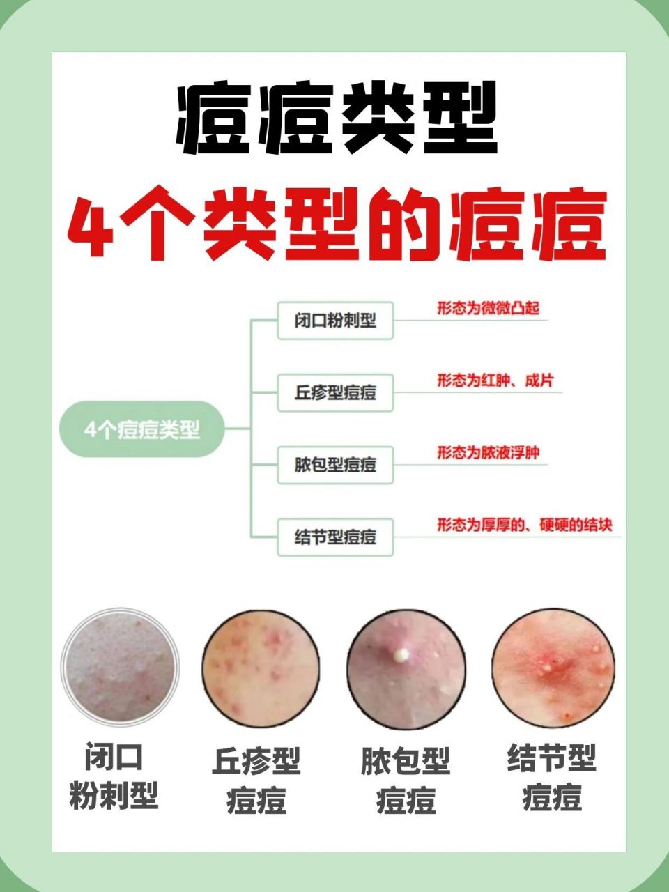 痤疮分为哪几种类型图片