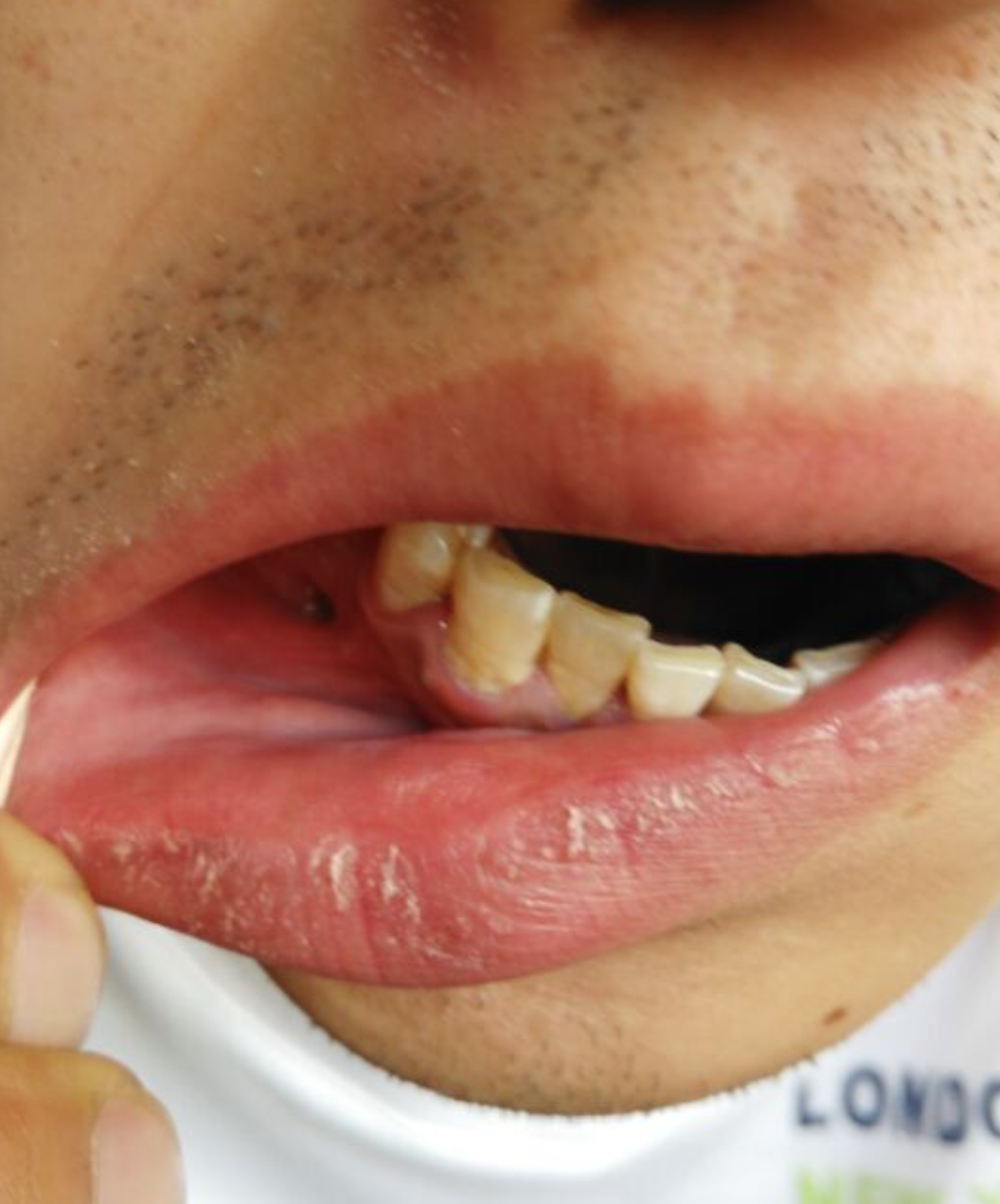 牙龈上有个小洞长期流脓,这种情况很可能是牙周脓肿引起的,要尽快去