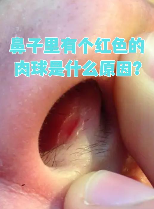 鼻子里出现红色肉球最常见的原因是鼻息肉或鼻血管瘤,这两种情况