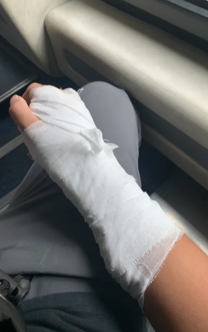 手腕包扎图片真实照片手部石膏固定照片受伤石膏手腕图片手腕伤包扎