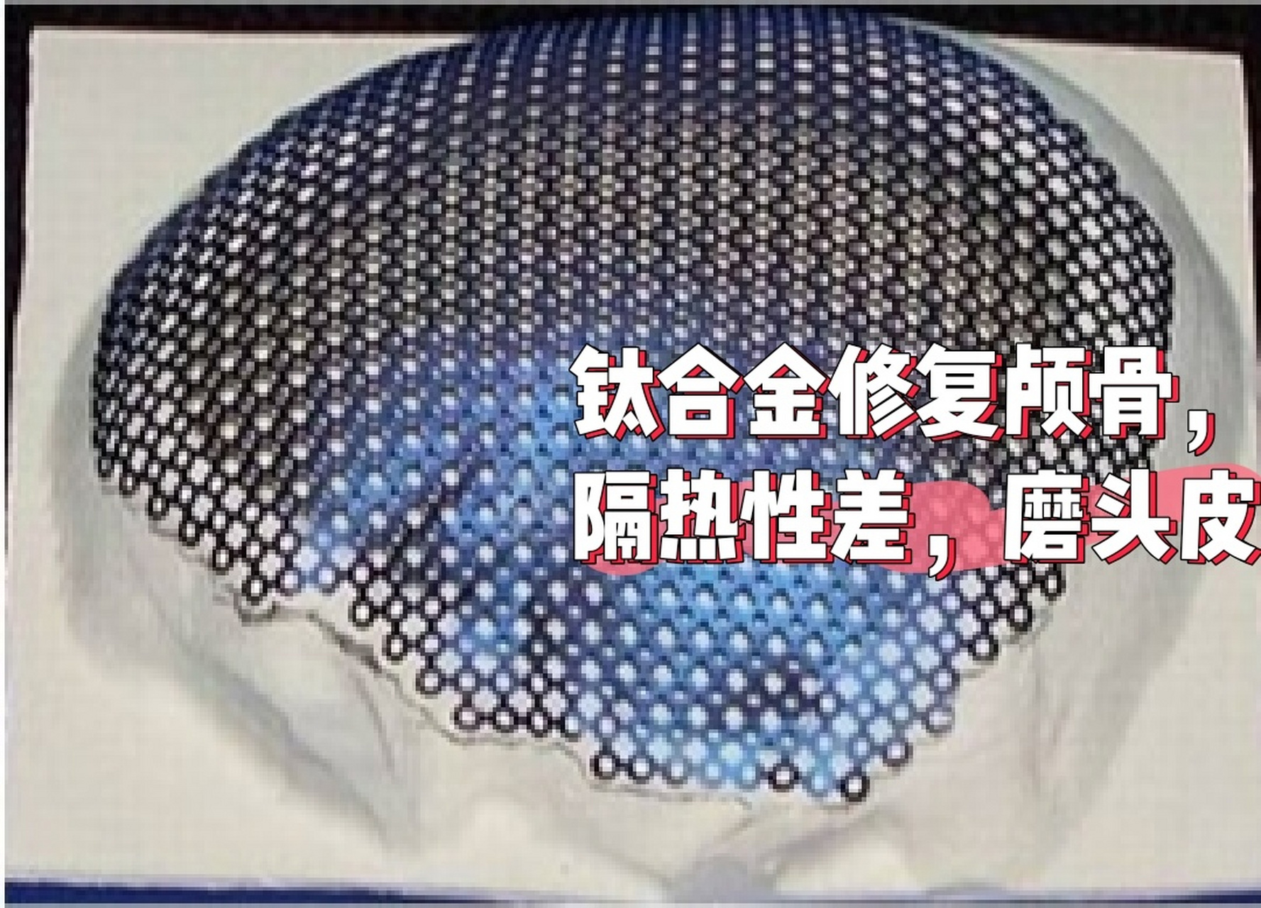 钛合金对比peek材料,哪种更适合修复颅骨 颅骨修补术是一项历史苯较