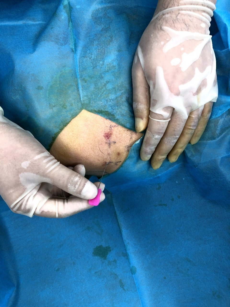 小针刀治疗腰臀肌筋膜炎 现在腰臀部疼痛的患者太多了,当普通的理疗