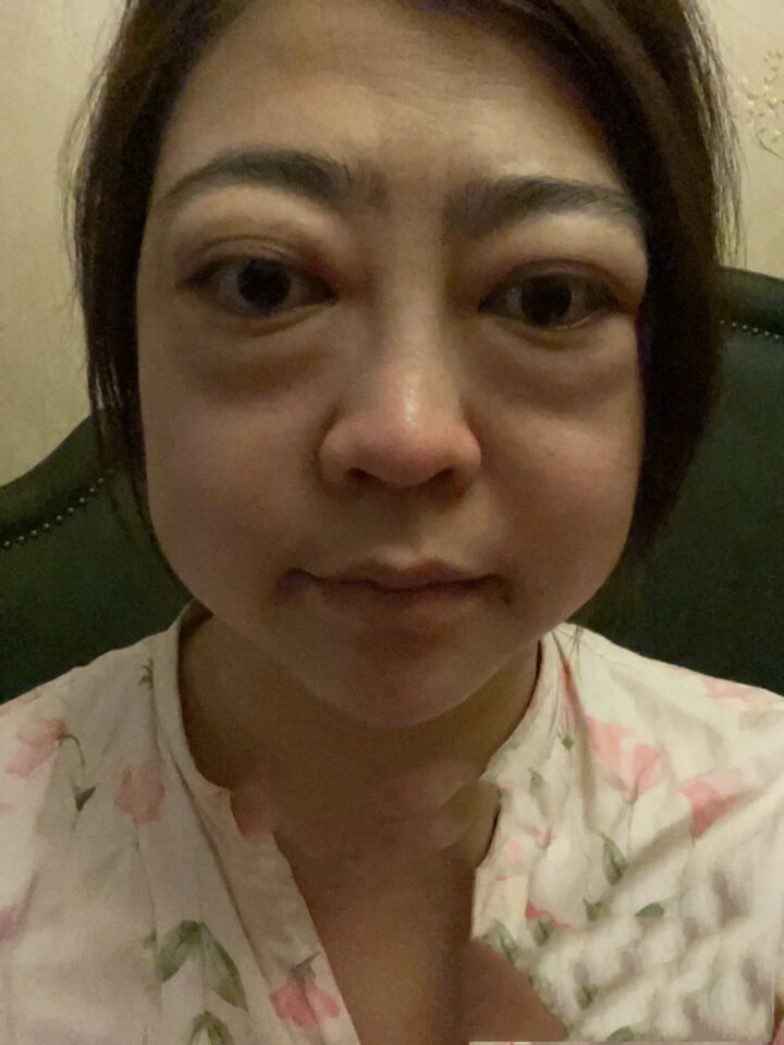 我的甲亢突眼经历 2019年怀揣着喜悦迎来了自己的宝贝 产后八个月谁也