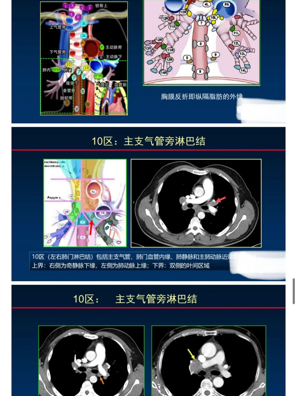 纵隔与肺门淋巴结的识别与精准ct分区