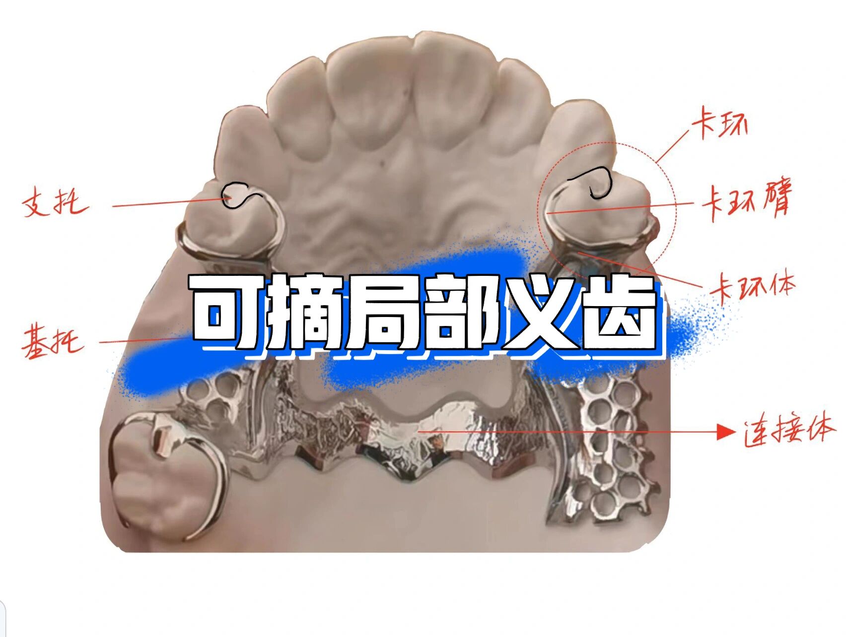 摘假牙套过程图解图片