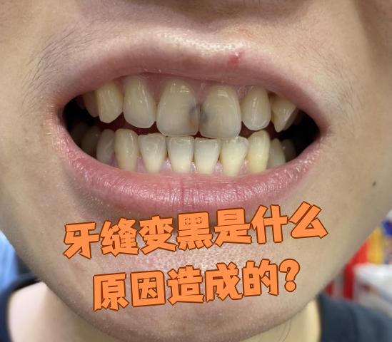 浓茶,咖啡或者有吸烟习惯,这些食物和烟草中的色素容易附着在牙齿表面