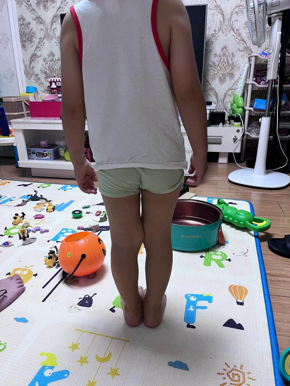 儿童腿弯 儿子3岁多,腿型这样,需要矫正吗?华西挂那个科好?