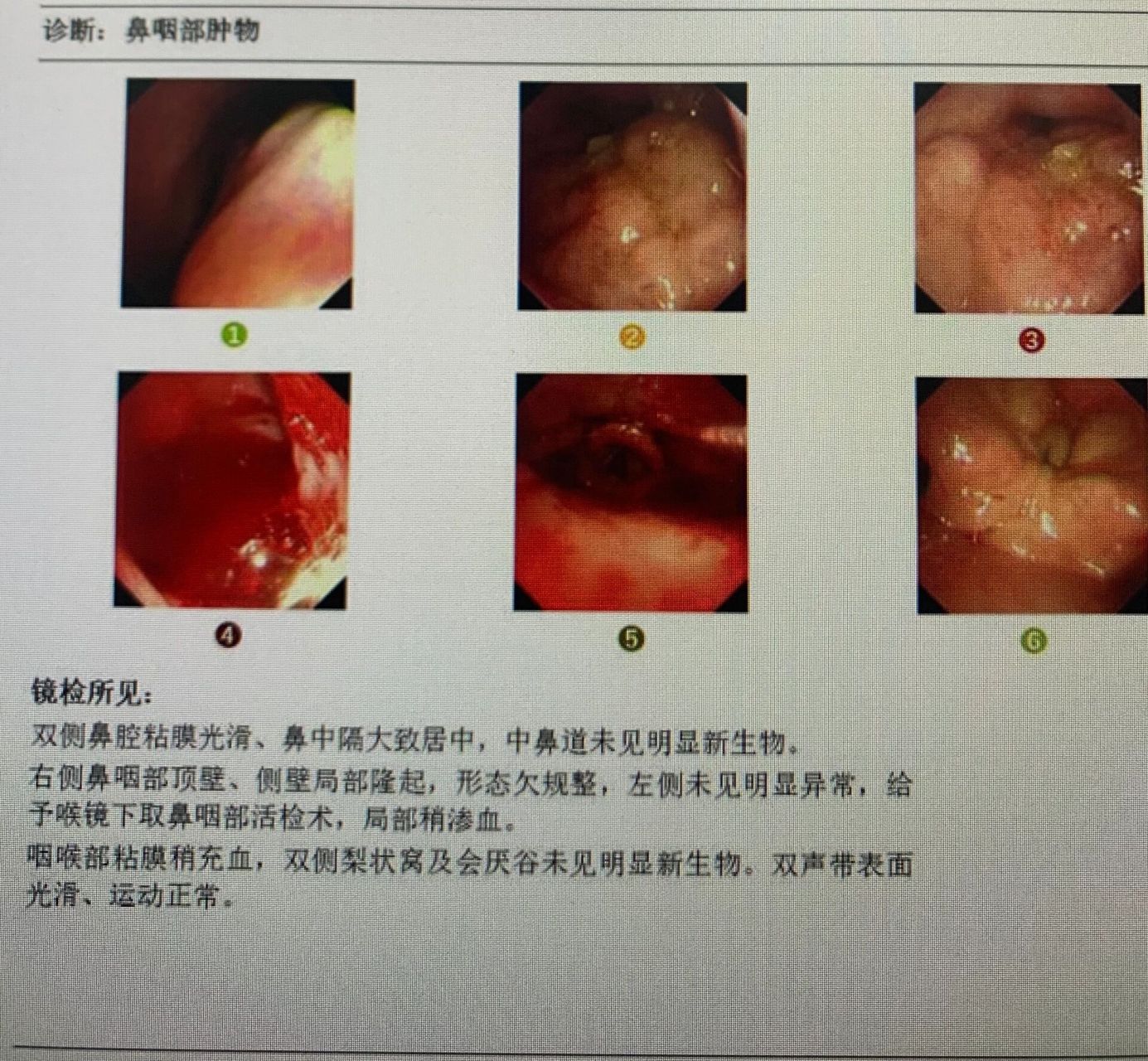 鼻咽癌早期症状 初期图片