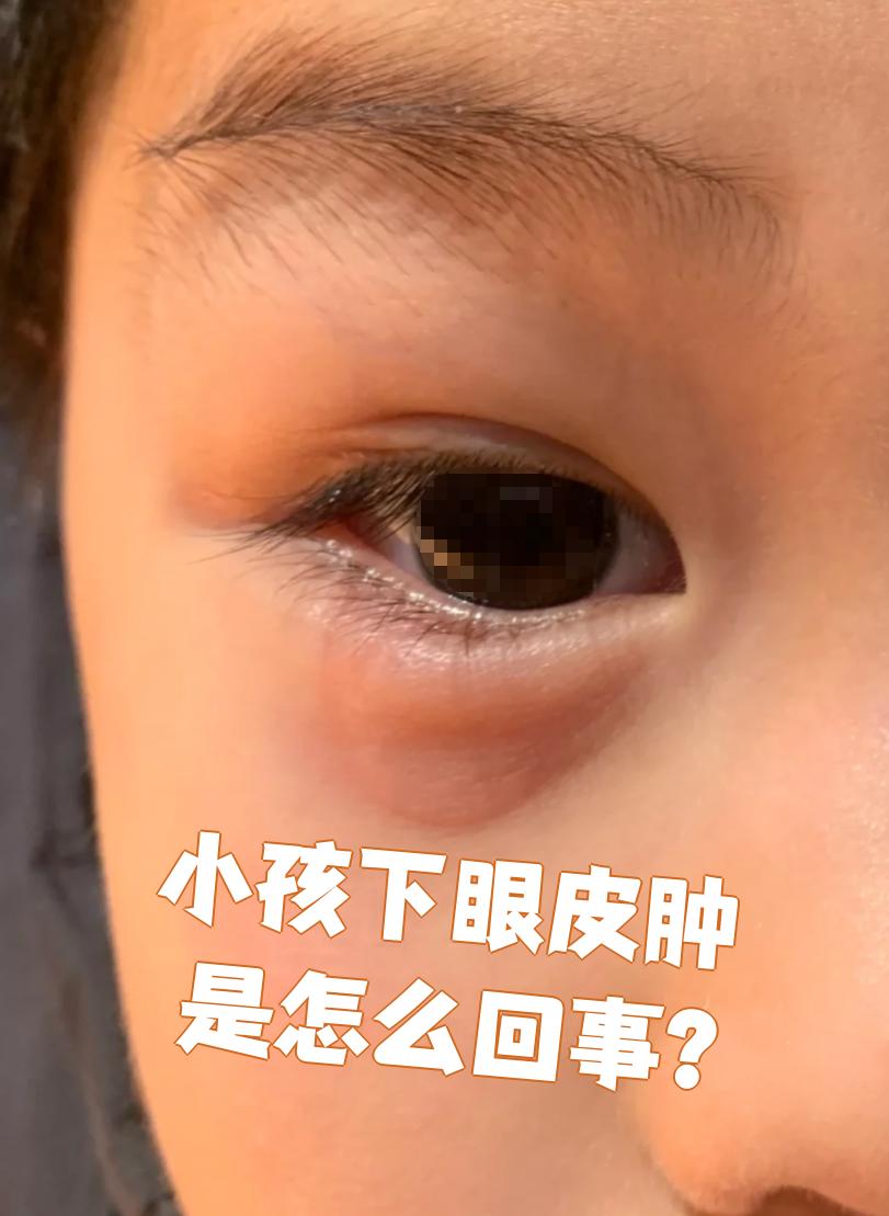 小孩下眼皮肿可能和睡眠不足,营养不良,过敏,结膜炎,肾炎这些原因有
