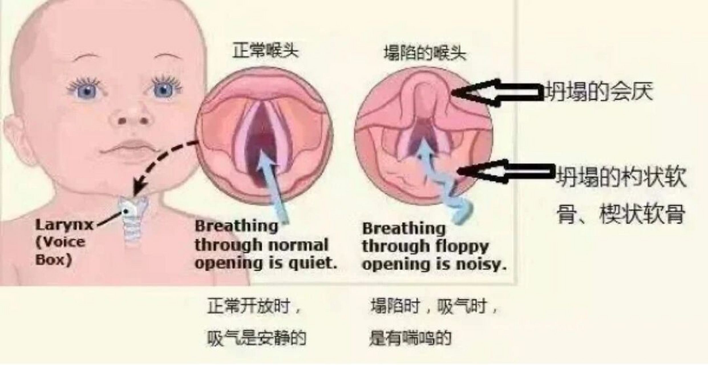 喉软骨发育不良的护理(上) 不知不觉宝宝已经6个多月了～我也马上要
