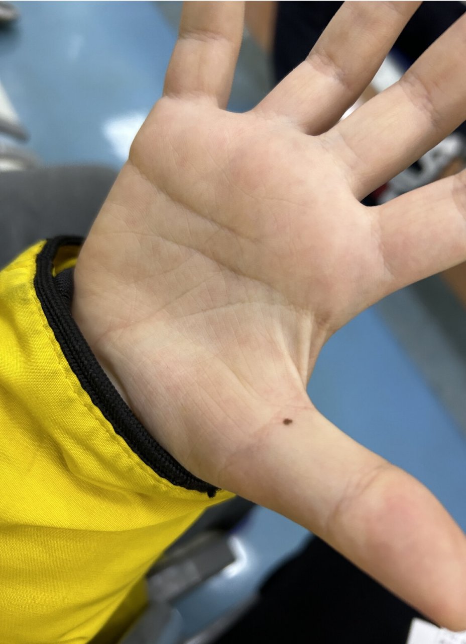 孩子手心长个痣竟然要手术 偶然一天老公发现孩子手心虎口处长了一颗