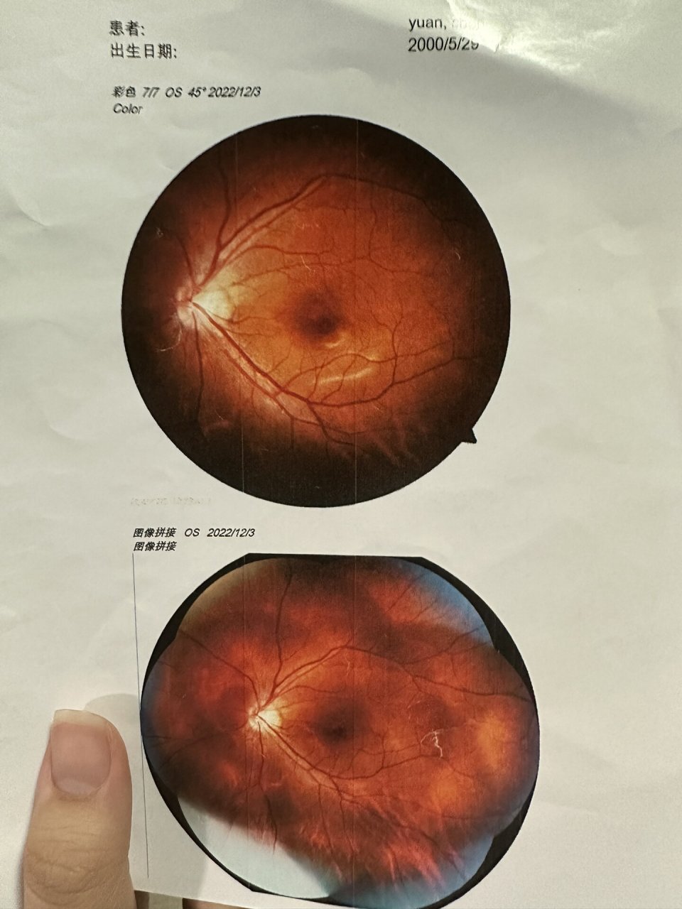 视网膜裂孔治疗经验分享(一) 92我先说一下我的情况吧,2014年底出现