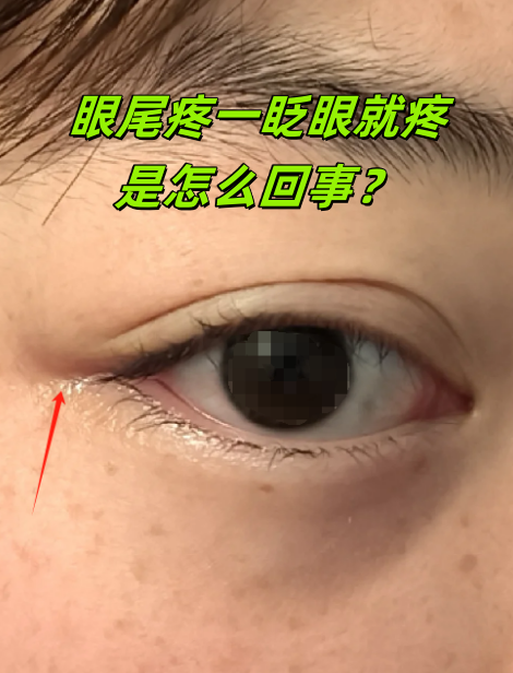 如果是倒睫,你会感觉眼尾有刺痛感,尤其眨眼时更明显