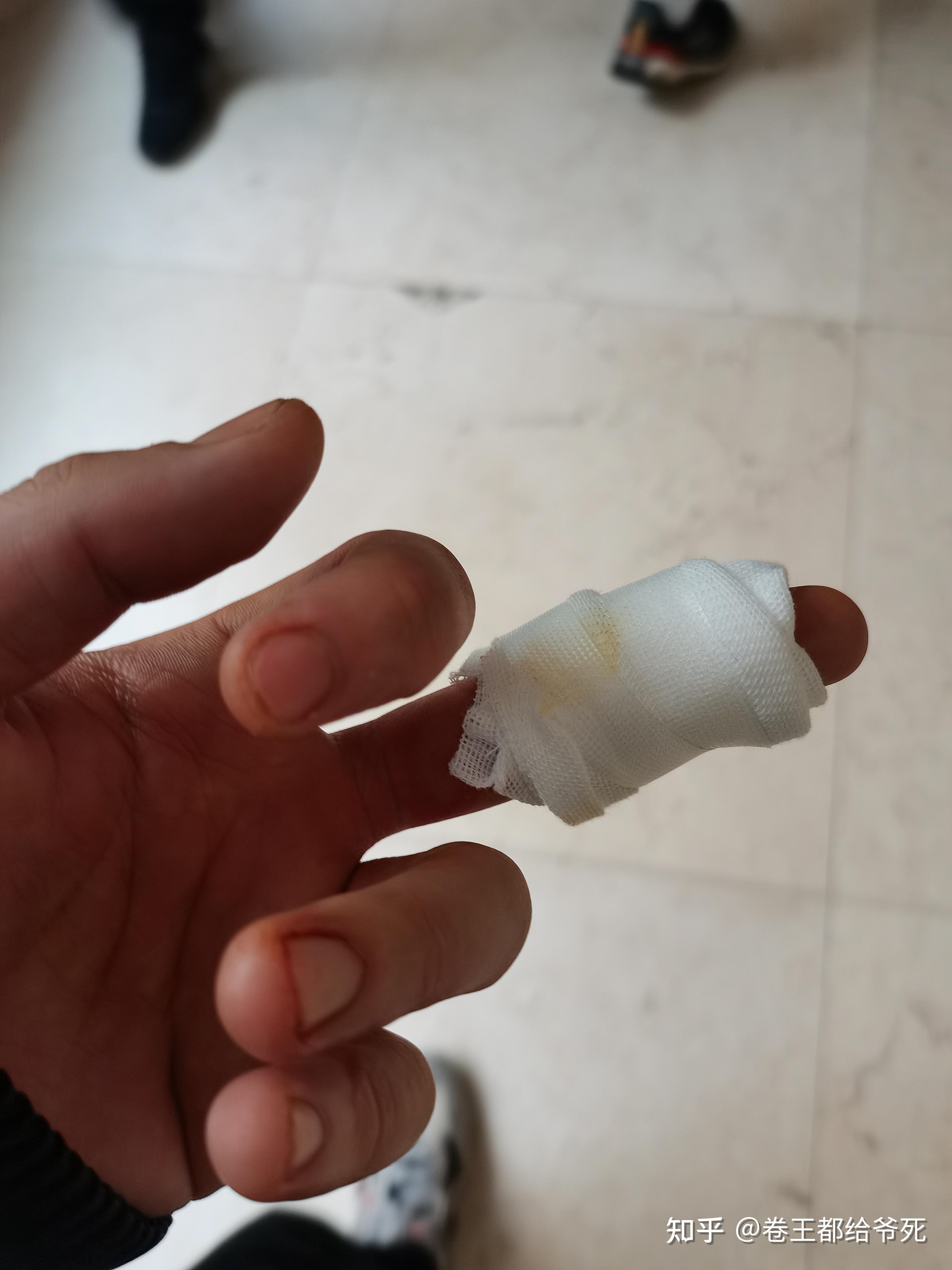 肌腱断裂恢复过程