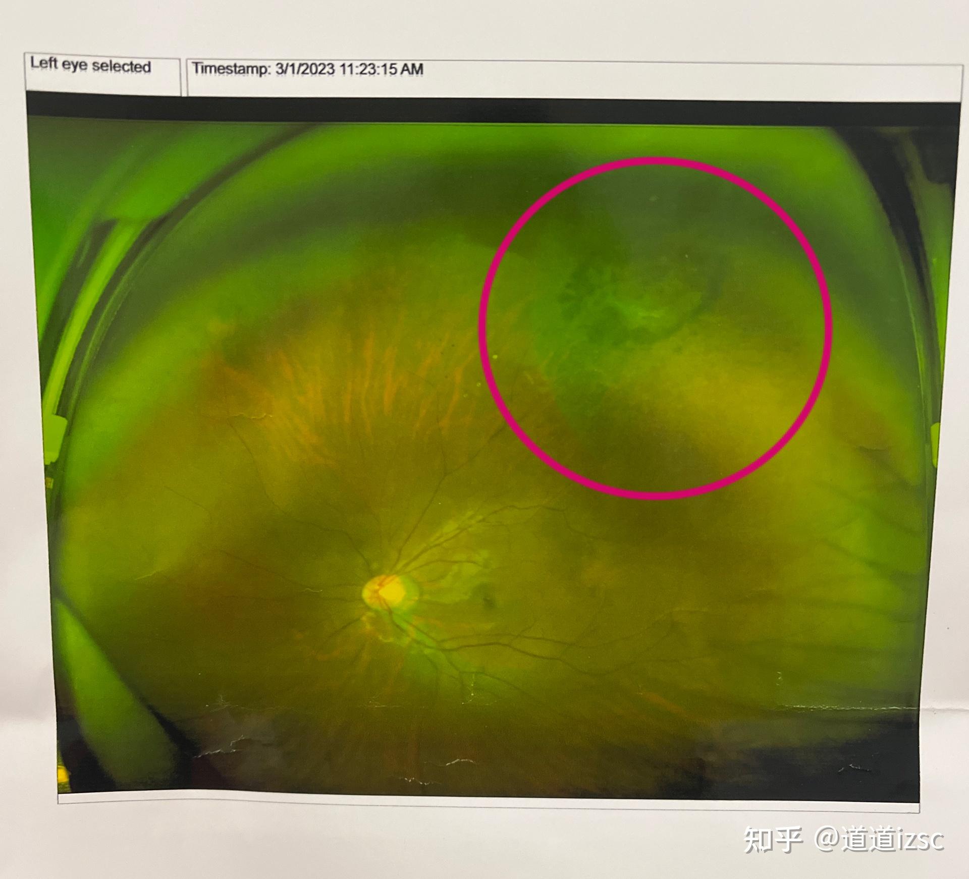 记一次视网膜裂孔术后