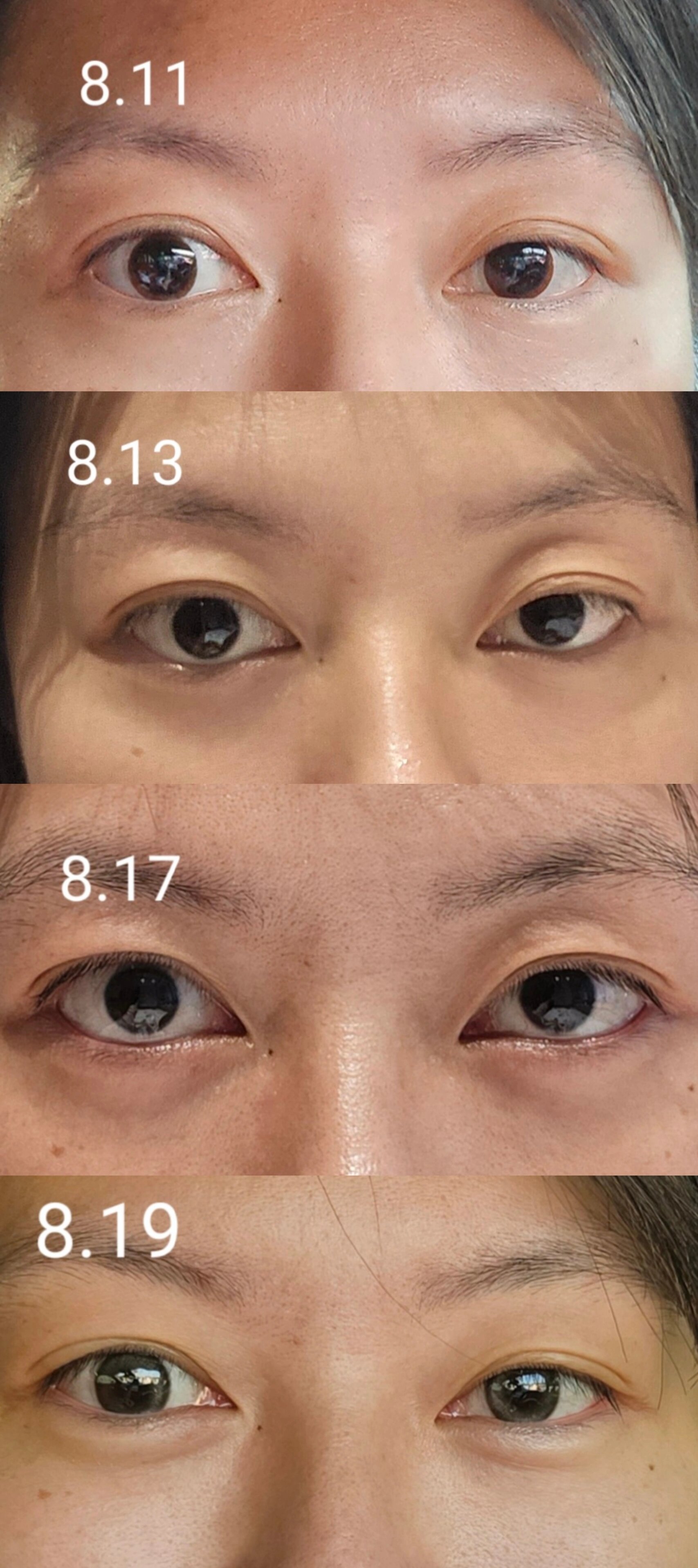 甲亢大小眼注射曲安奈德分享