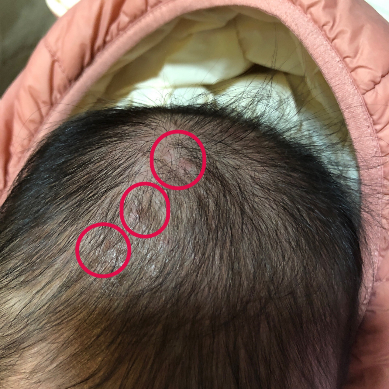 四个月宝宝头上长疙瘩 有哪位朋友知道这个红疙瘩是过敏还是湿疹呀?