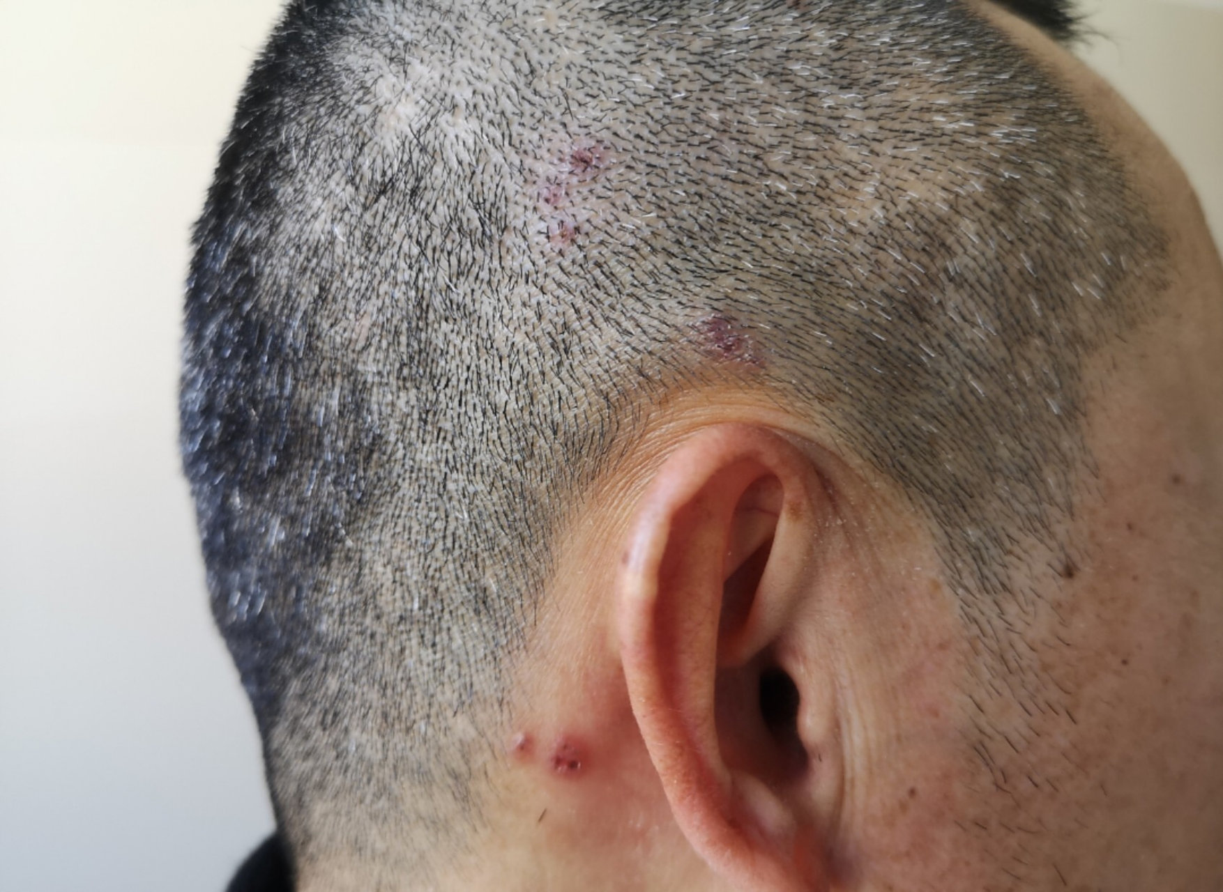 头上长的是带状疱疹! 病程5天,患者经网上搜索自认为是毛囊炎.