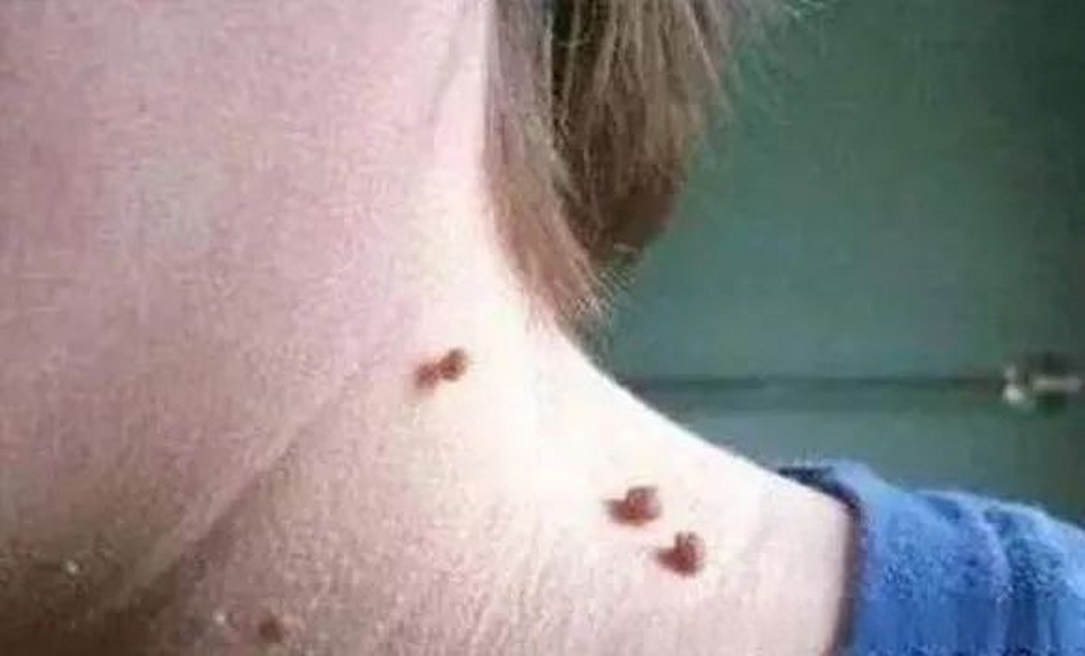 常见的几类皮肤疣及防治办法   皮肤疣根据皮损形态