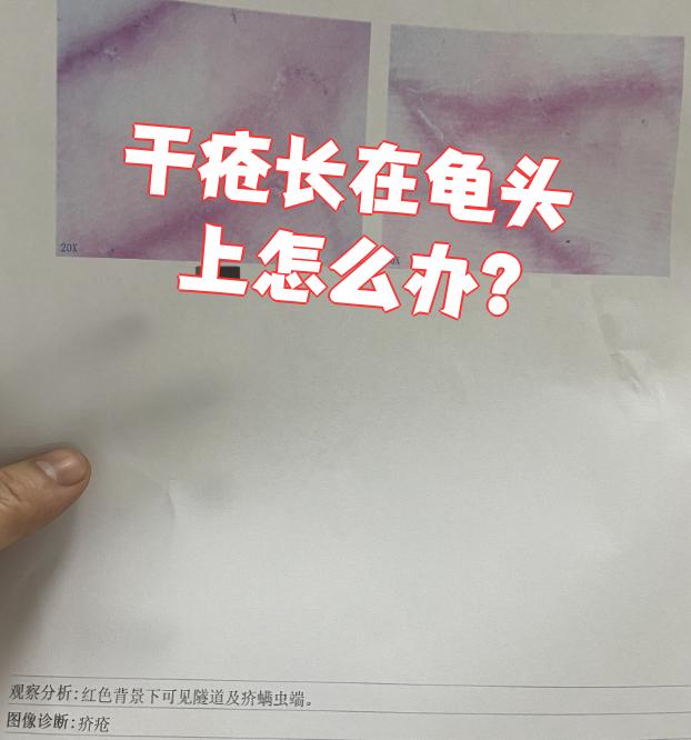干疮长在龟头上怎么办?