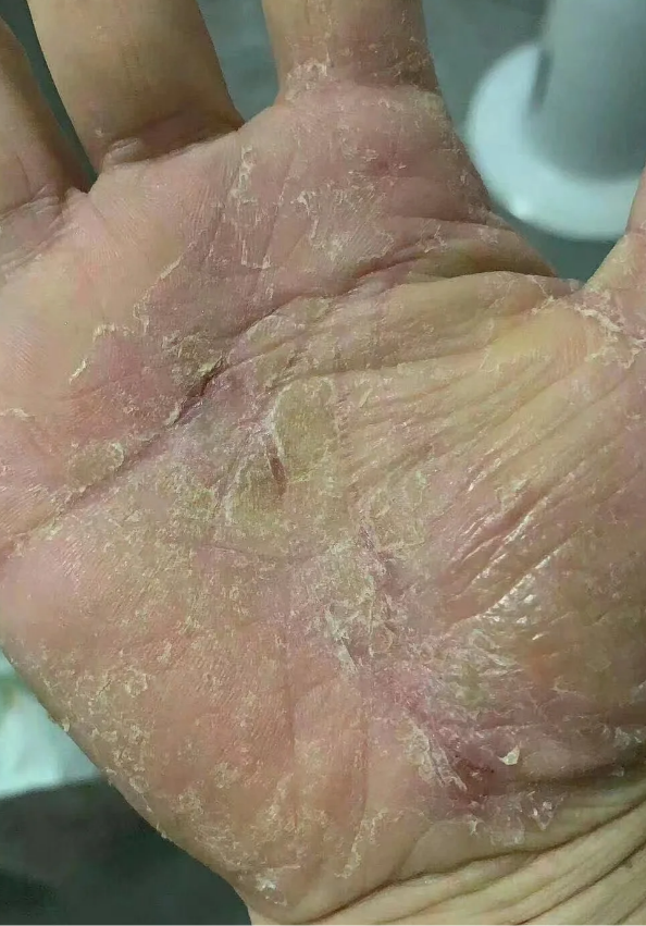 鹅掌风也叫手癣,是真菌感染引起的手部皮肤病