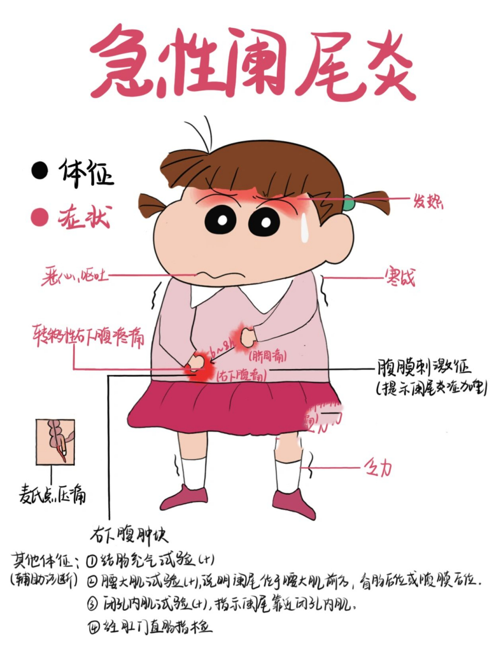 医学生笔记94|急性阑尾炎02 急性阑尾炎是引起急性腹部疼痛最常见