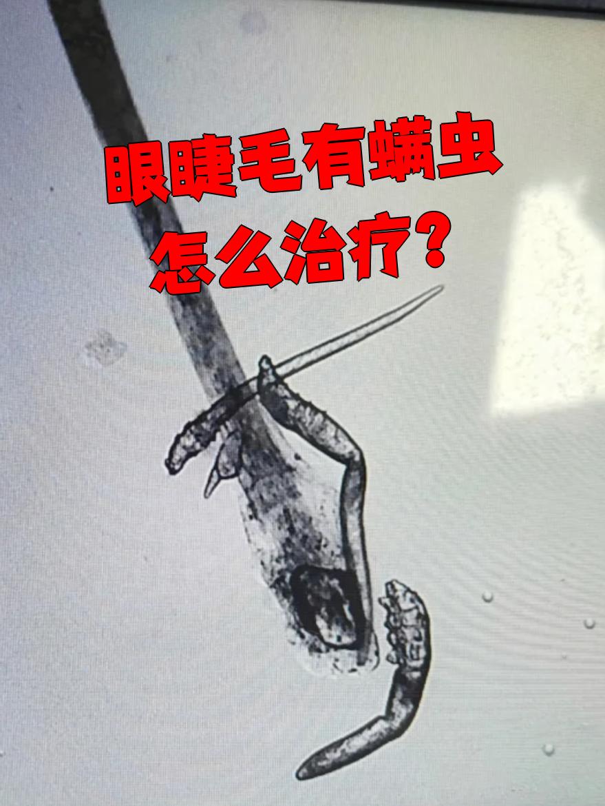 眼睫毛有螨虫需要及时治疗,主要方法包括局部用药和全身用药,同湿要