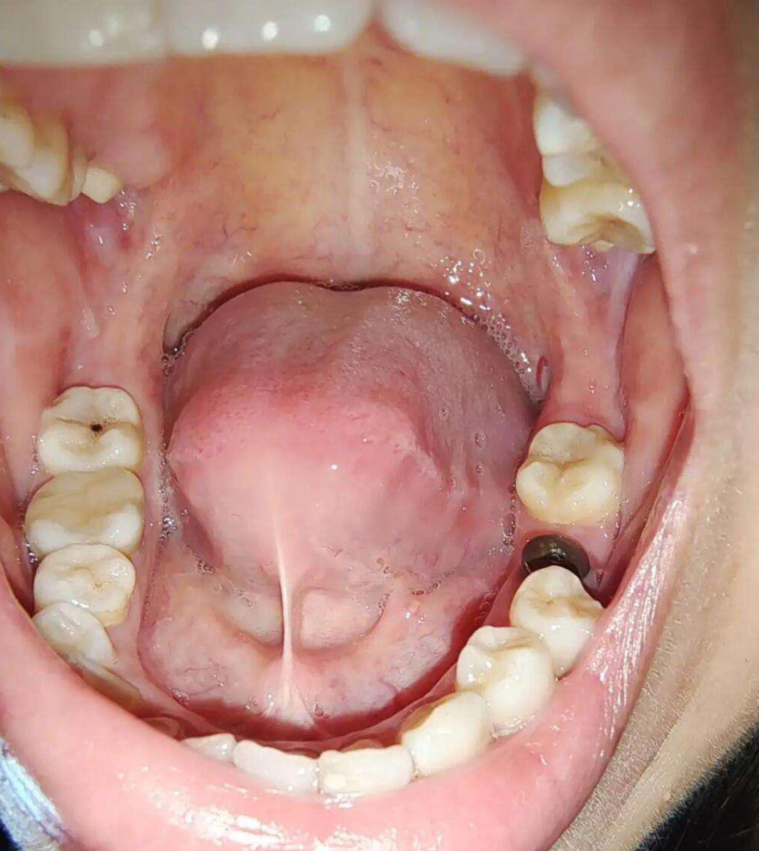 用智齿代替其他缺失的牙齿通常不可行,这可能会对口腔健康造成影响