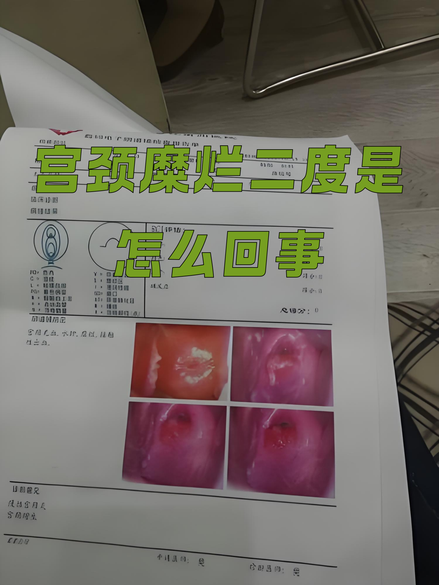 宫颈糜烂二度是怎么回事