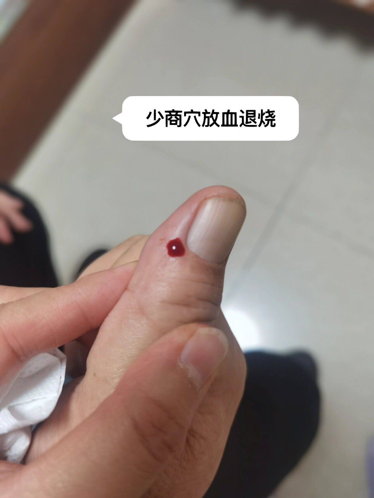 拔血罐,刺络放血…你不能不知的退烧方法 爷爷发烧,血压同时飙到159
