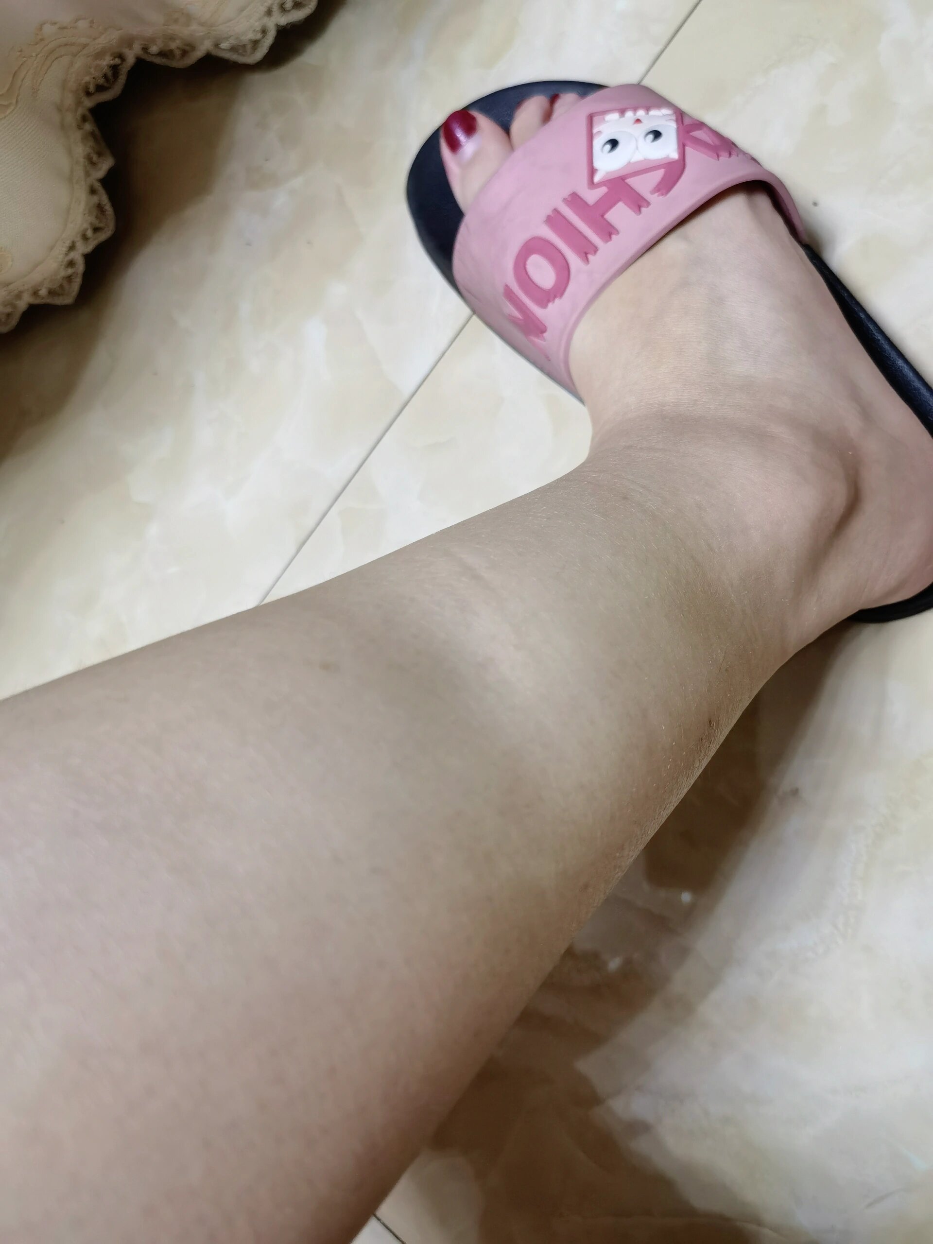 右小腿外侧凹进去个坑 求答疑