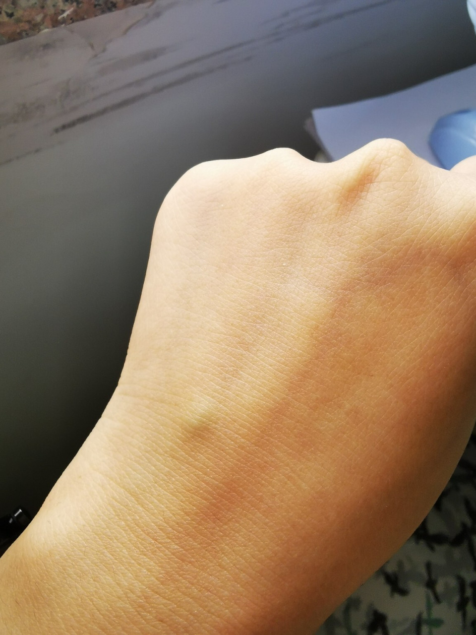 求助贴 大家好,前段时间打点滴,后面好了之后手上血管突出来了,按下去