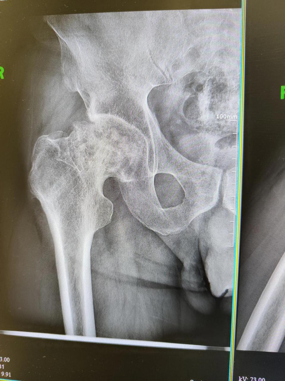 北京患者股骨头坏死的图片第一张,第二张拍照于2023年6月26日