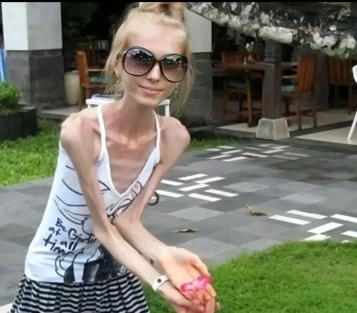 还是赶紧找专业人士看看吧,这名女子的身高只有1米6,体重25公斤.