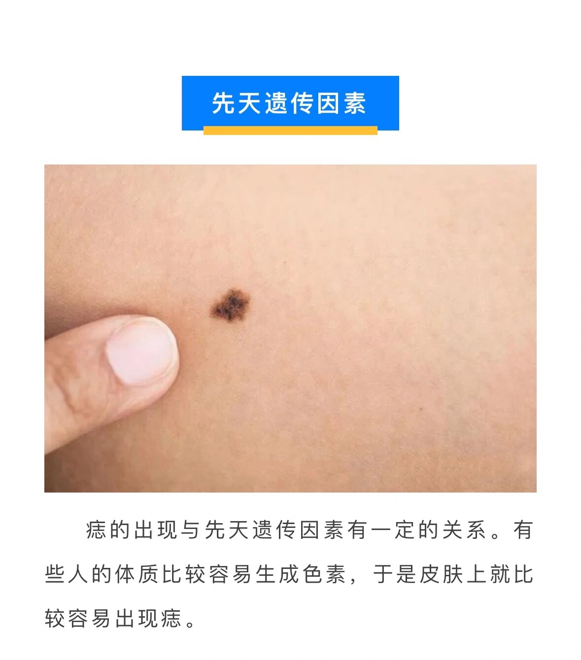 痣是怎么形成的