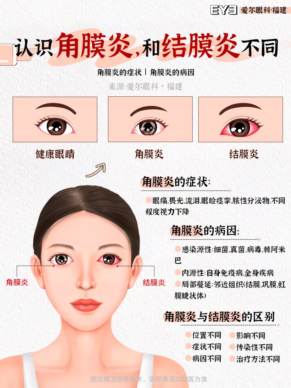 很多人分不清,角膜炎和结膜炎究竟区别在哪 角膜炎是一种严重的致盲性