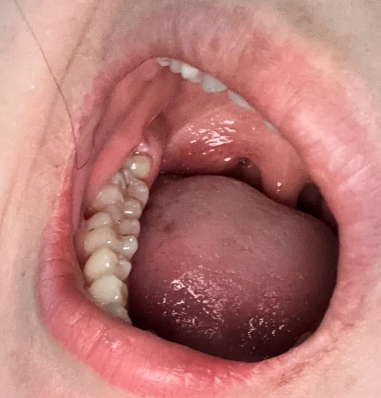 因为横生智齿和第二磨牙挨得很近,中间容易卡食物,时间长了会发炎