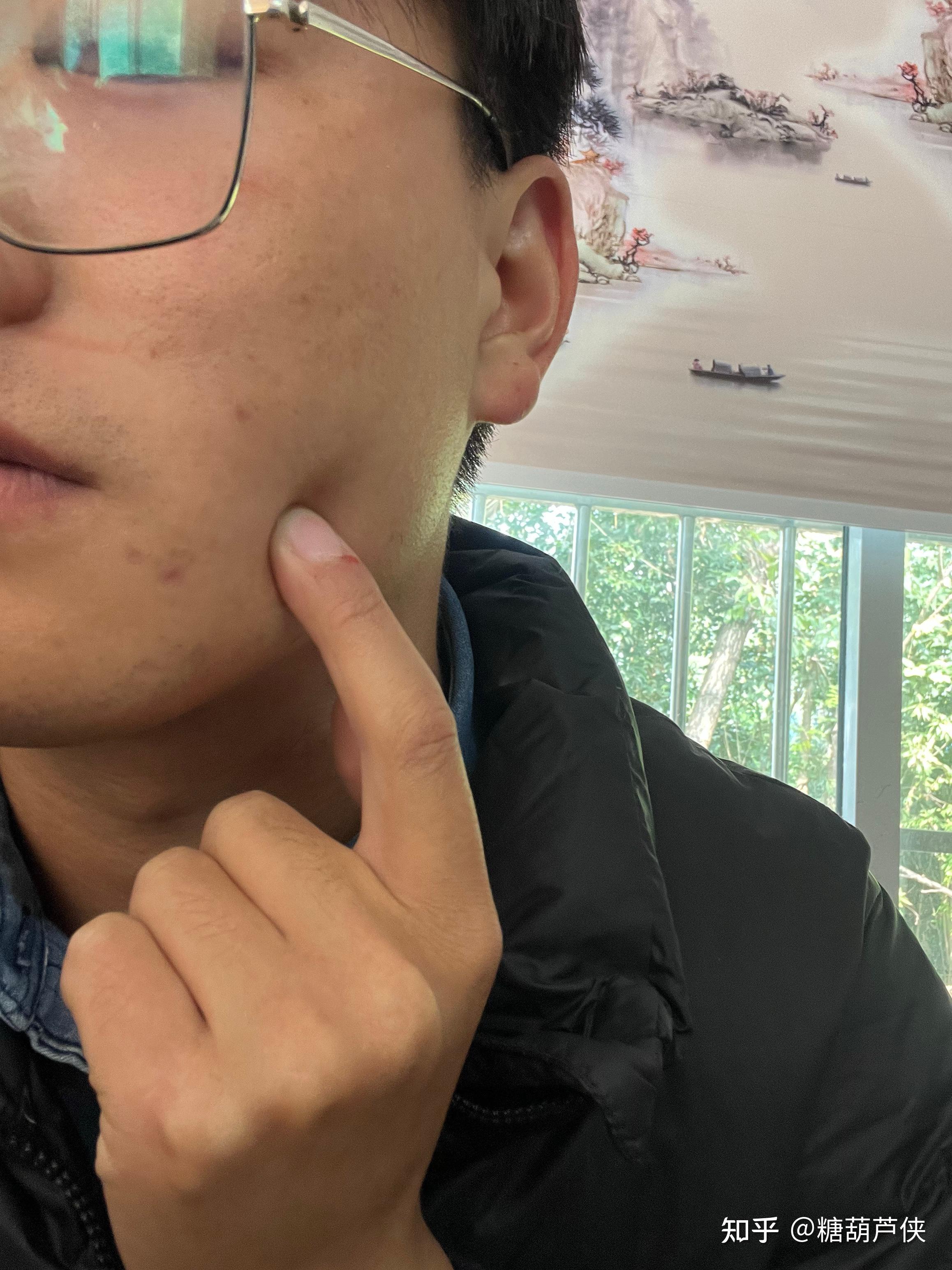 感觉脸颊里面有一个肿块