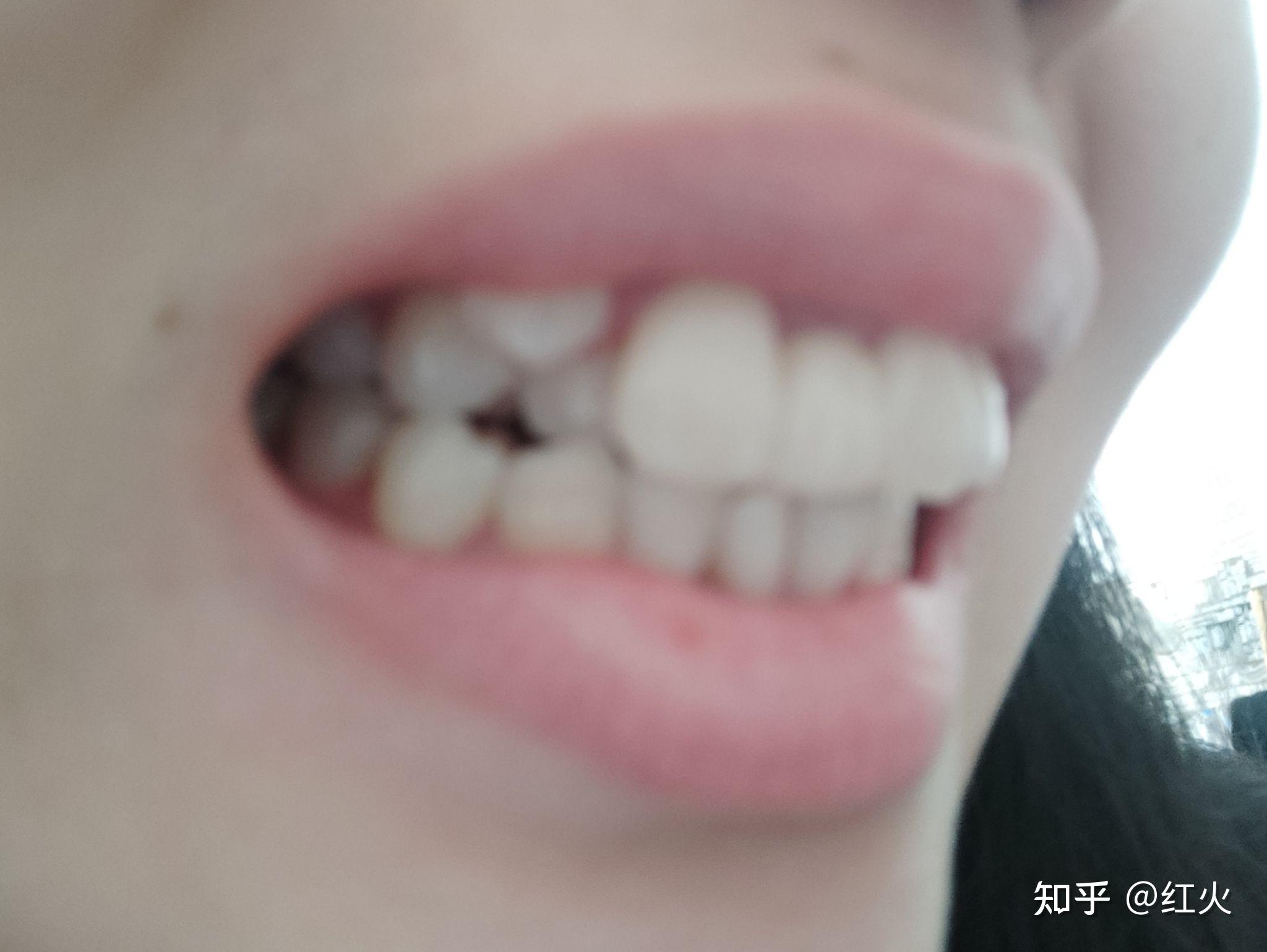 多生牙虎牙和其他牙重叠