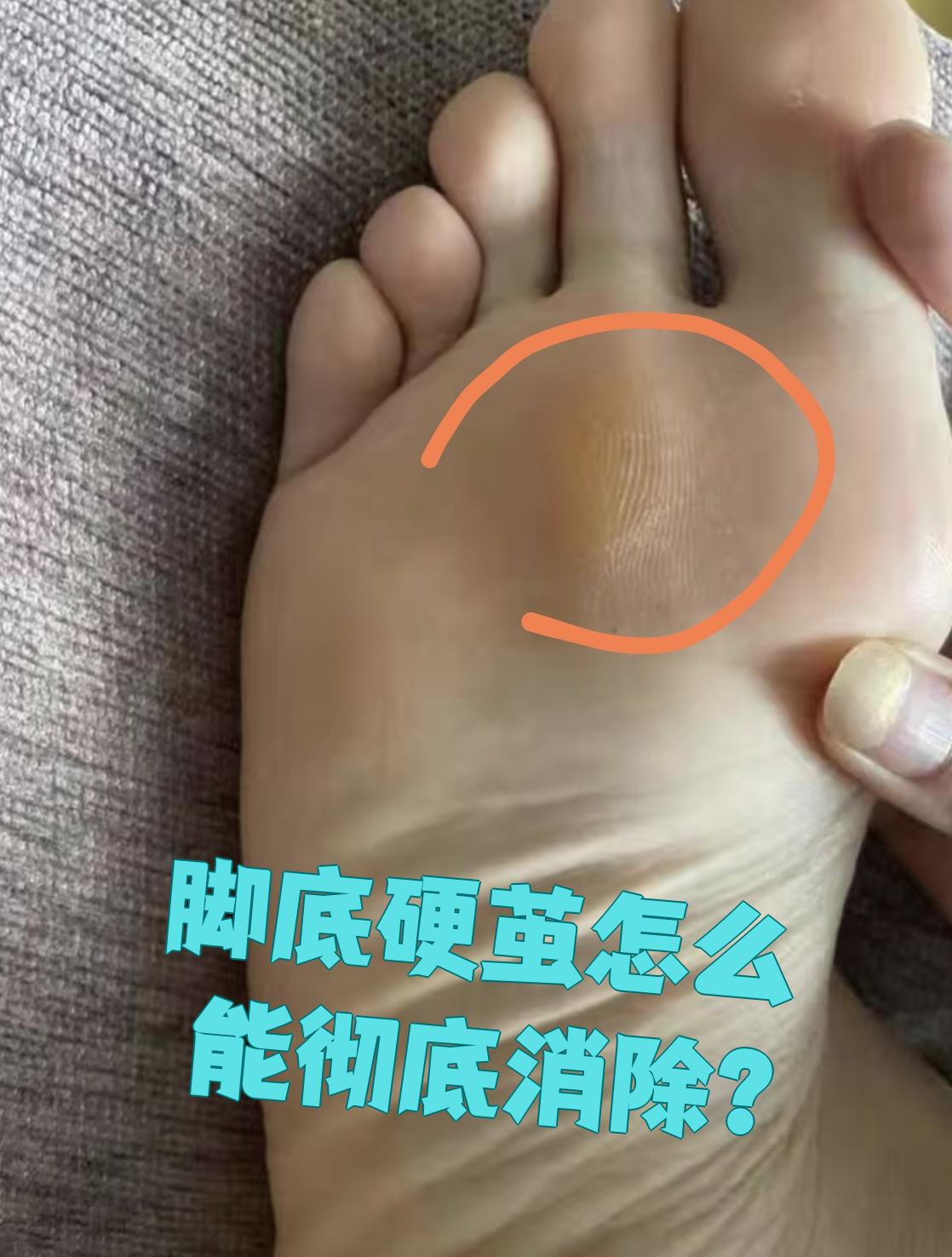 脚底硬茧医学上叫胼胝,是因为皮肤反复摩擦导致的角质层增厚