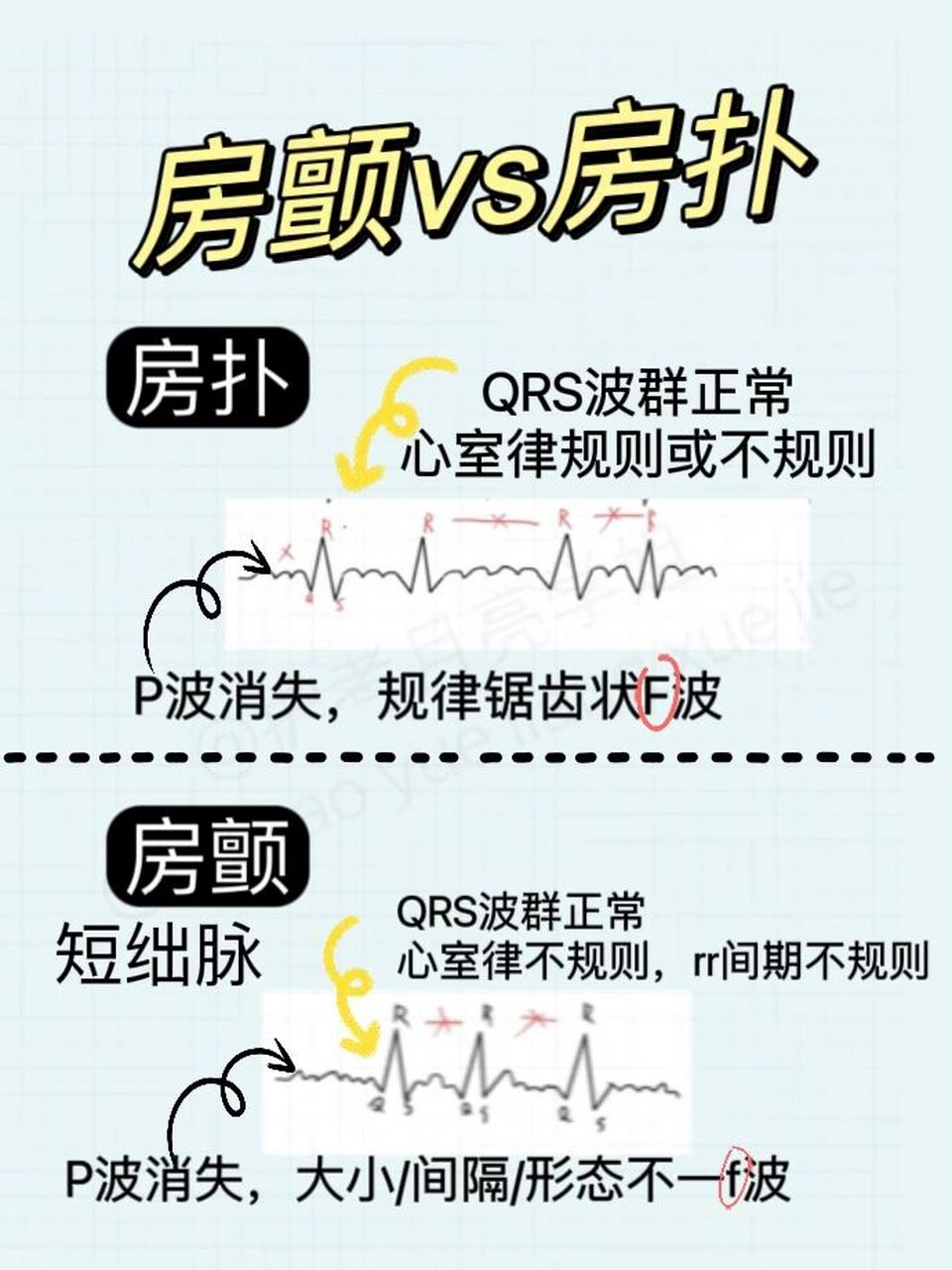 73护考笔记房颤和房扑总结 今天总结一下房颤和房扑,上次视频有详细