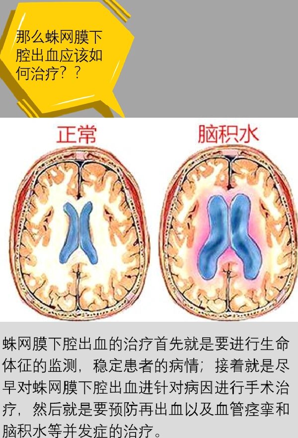 颅内动脉瘤十问之三"破裂动脉瘤该如何治疗"        经过上一期的介绍