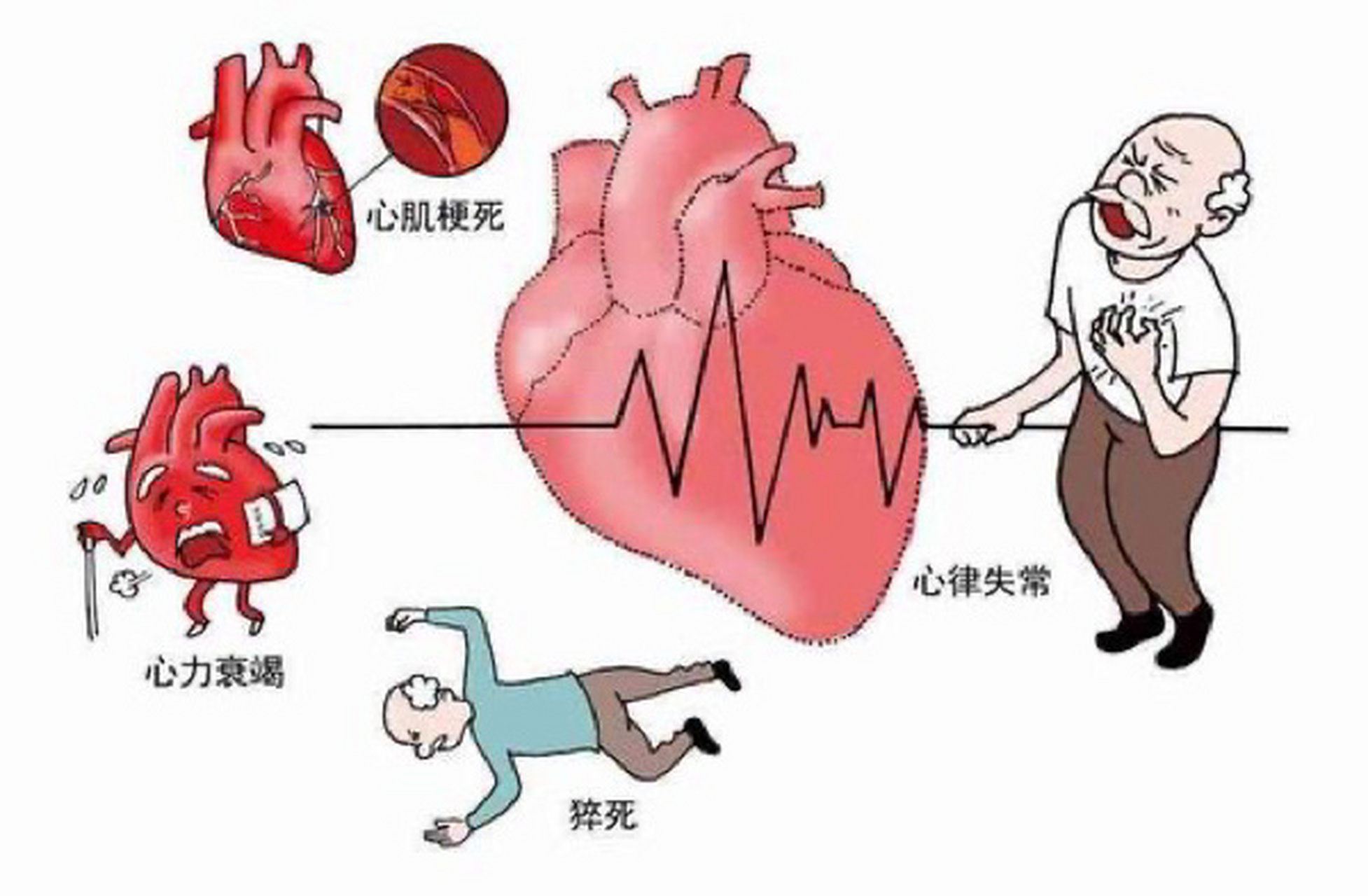 什么是冠心病图片