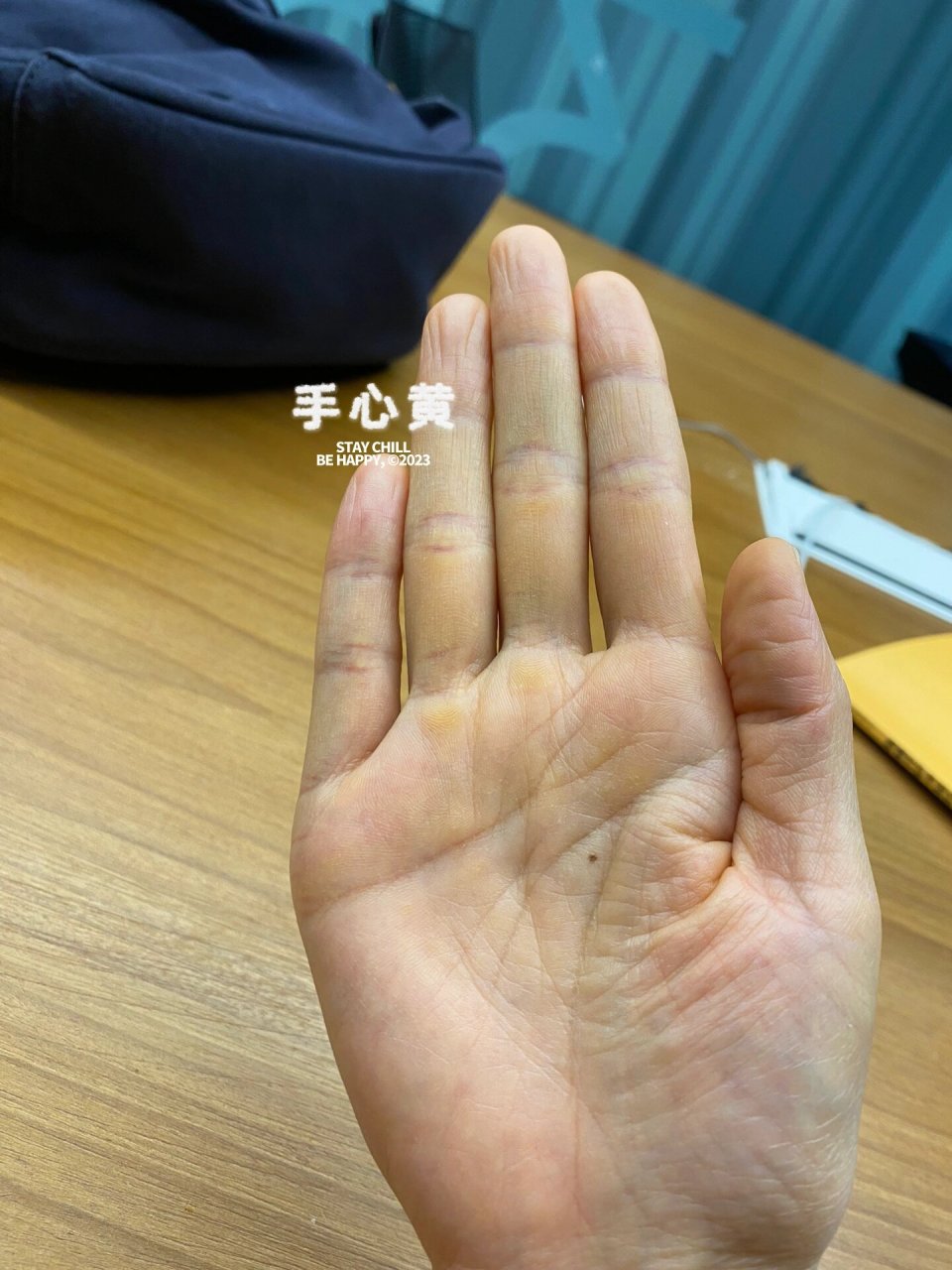 手掌太黄啦 手心一直发黄,检查过肝的,医生说没问题,平常摄入类黄素的