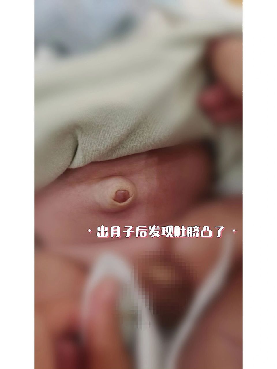 出月子之后的某天突然发现肚脐眼凸出来了,一开始没在意,以为肚子撑