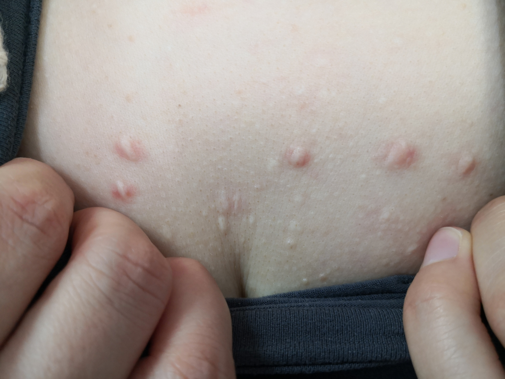 前胸的瘢痕疙瘩症状.#瘢痕疙瘩