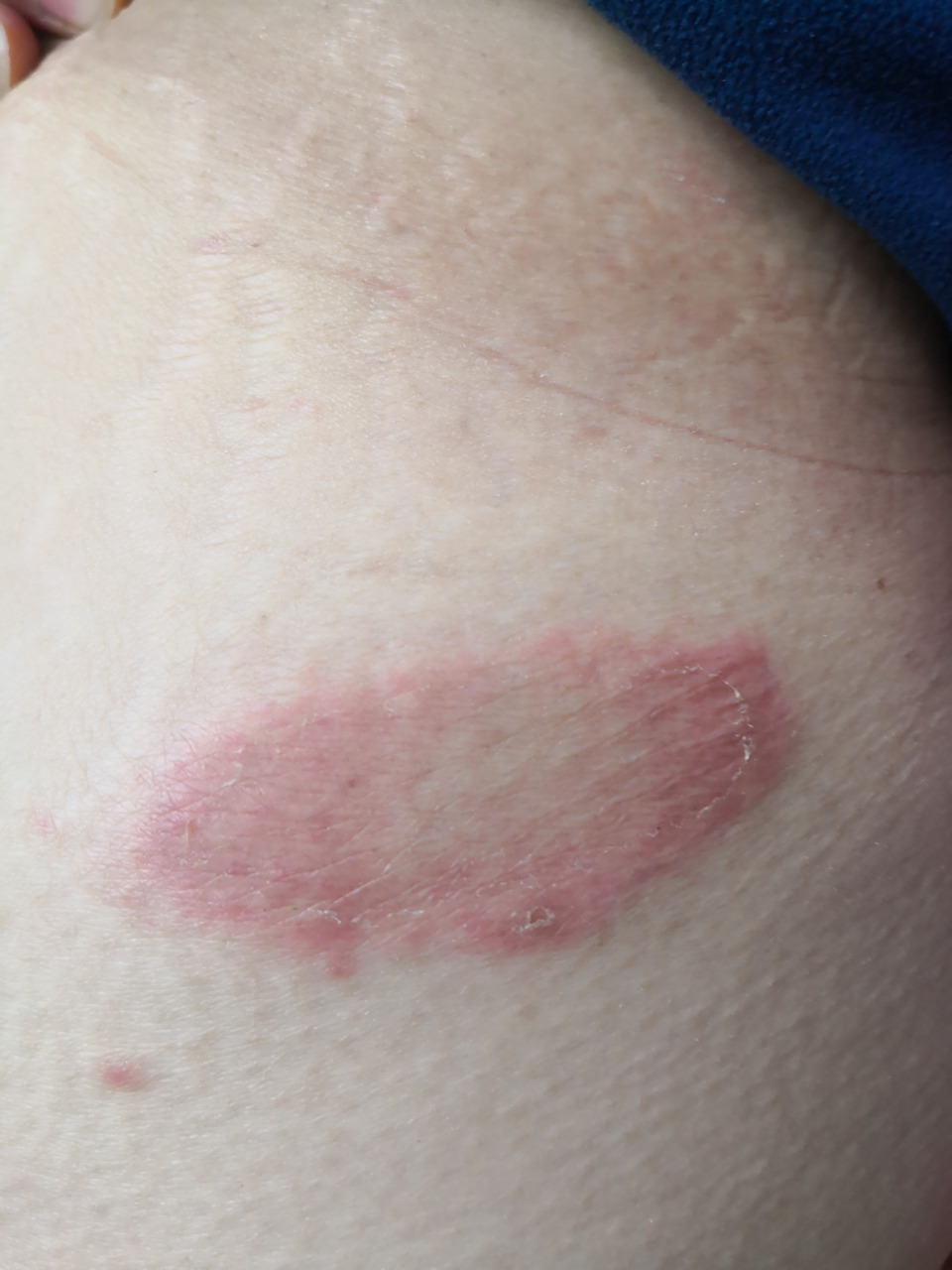 玫瑰糠疹症状#解决皮肤问题专注皮肤美容##玫瑰糠疹# 椭圆形皮损,有母